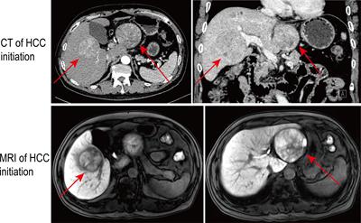 Case Report: A case of hepatocellular carcinoma with aberrant right hepatic artery treated with transarterial chemoembolization and infusion chemotherapy separately to bilobar lesion combining with systemic therapies and sequential hepatectomy